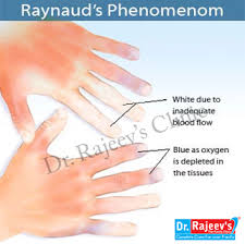 homeopathic treatment for raynaud s