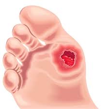 This occurs due to nerve compression. Foot Ulcers Causes Symptoms And Treatment Options