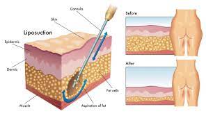lipo scars liposuction scar management