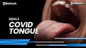 Kebanyakan orang yang terinfeksi mengalami penyakit ringan dan sembuh, tetapi bisa lebih parah bagi yang lain. Many People Have Experienced It Swollen Tongue Could Be A Sign Of You Are Exposed To Covid 19 Netral News