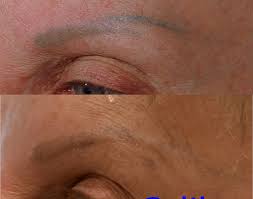 permanent makeup removal before after