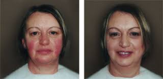 cover rosacea with airbrush makeup by