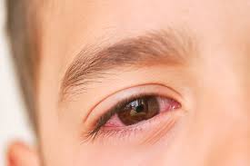 three types of pink eye and how to
