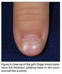abnormal fingernails pediatric annals