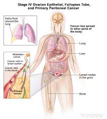 It results in abnormal cells that have the ability to invade or spread to other parts of the body. Definition Of Stage Iv Ovarian Epithelial Fallopian Tube And Primary Peritoneal Cancer Nci Dictionary Of Cancer Terms National Cancer Institute