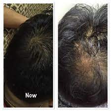 how to stop hair loss and regrow hair