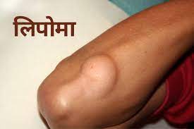 lipoma treatment in ayurveda ल प म
