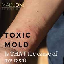 is toxic mold the cause of my rash jpeg