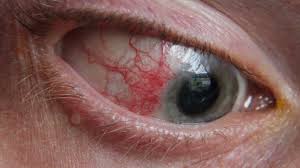 episcleritis symptoms causes and