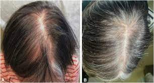hair regrowth in endocrine therapy