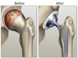 anterior approach total hip replacement