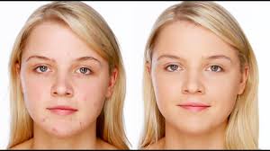 best acne makeup tutorial you