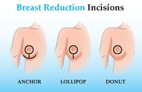 Breast Reduction Before After Lipstick Alley