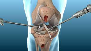 knee ligament surgeries aptiva health