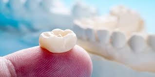 dental tooth crown procedure in