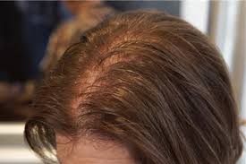 Hair loss in some cases results in changes in the secretion of hormones in the body, which is affected by the thyroid gland, so any defect in the thyroid gland makes. As They Age Women Lose Their Hair Too Which Treatments Really Work