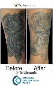Having said that, you are here because you want to learn about the choices and methods of tattoo removal, and so we have listed and explained on. Uncategorized Laser And Non Laser Tattoo Removal Tattoo Regret