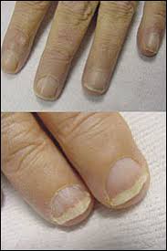 Check spelling or type a new query. Nail Abnormalities Clues To Systemic Disease American Family Physician