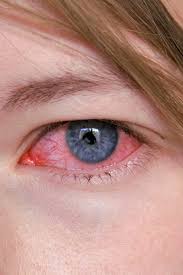what causes pink eye heffington s