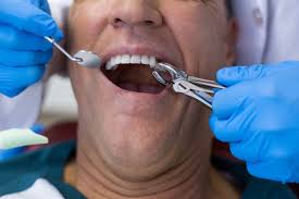 breath smell after tooth extraction