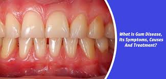 what are gum disease its symptoms