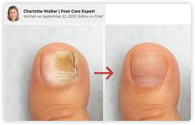 is laser treatment good for nail fungus