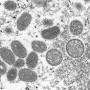 1 000 cas de variole du singe détectés, l'OMS craint que le virus s
