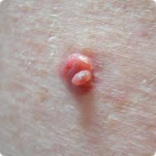 An additional category of malignant melanoma of the skin, i.e. Melanoma Skin Cancer Melanoma Cancer Skin Melanoma Melanoma Moles