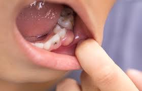 effective home remes for gum pain