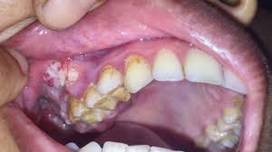 is cancer painful what mouth
