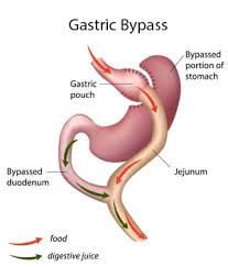 gastric byp revision surgery 6