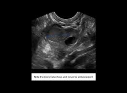 Case Study     Lateral Epicondylitis   Musculoskeletal Sonography March      Case Studies from the MaRS Innovation portfolio Ultrasound Based  Cancer Treatment Monitoring    