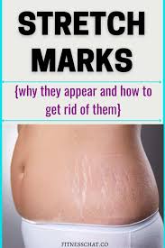 how to remove stretch marks fast 5
