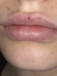 red dot on lip after lip filler still