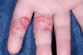 Swollen, inflamed fingers and toes. Pompholyx Dyshidrotic Eczema Nhs