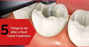 If several visits are required, a temporary filling will be placed in the crown before the tooth is permanently restored. 5 Things To Do After A Root Canal Treatment Expert Dental Care