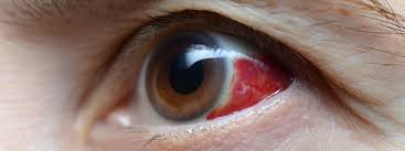 8 common causes of an eye infection