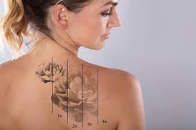 The age of the tattoo also affects the number of laser removal sessions needed to erase it. Laser Tattoo Removal Miami Less Time Better Results Miami Skin Spa