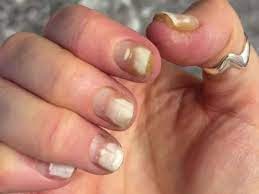 gel nail polish side effects