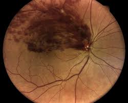 retinal vein occlusion orlando retina