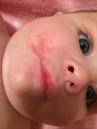 rash around mouth pic babycenter