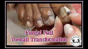 thick fungal toenail transformation