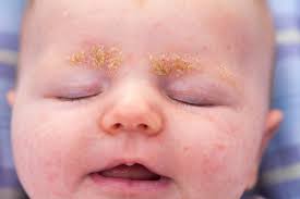 Cradle cap on other parts of the body. Cradle Cap Nhs