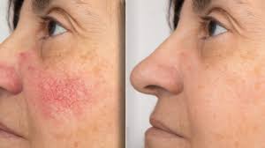 what is rosacea what causes it and how