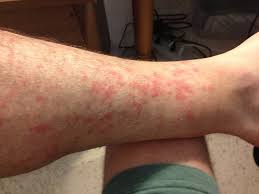 red rash between knee and ankle after