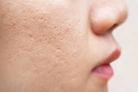 acne scar reduction virginia