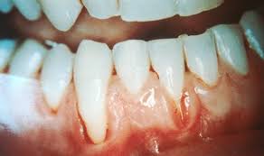 5 ways that gum recession can be