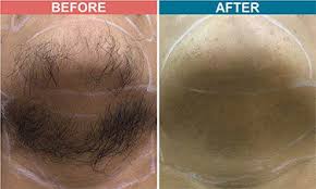 diode laser hair removal cost in jaipur
