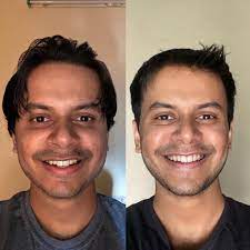 Overbite is a term used to describe the overlap of your upper front teeth in relation to your lower front teeth. Week 1 Vs Week 26 23 37 Overbite Correction With 4 Premolar Extractions Invisalign