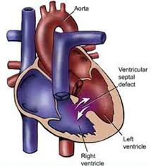 Therefore, they may be likely to delay emergency medical treatment. Hole In The Heart